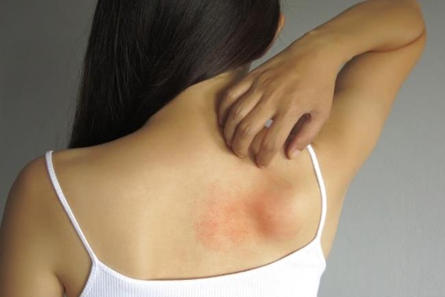 אישה מגרדת את גבה האדום כתוצאה מאלרגיה, פרדניזולון